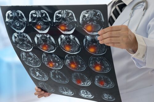 Schmuckbild. Hände eines Arztes im weißen Kittel halten einen Film mit MRT-Scan eines Gehirns mit Gehirntumor (Quelle: istockphoto.com, von utah778, #821471224)