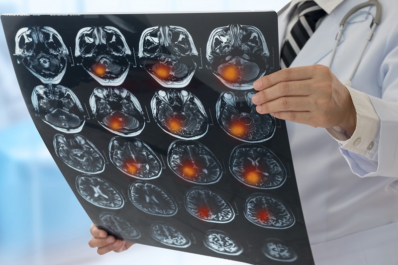 Schmuckbild. Hände eines Arztes im weißen Kittel halten einen Film mit MRT-Scan eines Gehirns mit Gehirntumor; verlinkt zur 'Klinik für Neurologie'