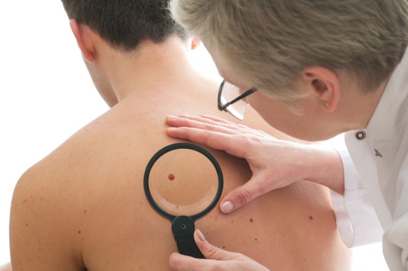 Schmuckbild. Blick über die Schulter eines Arztes, der mit einer Lupe einen Leberfleck auf dem Schulterblatt eines männlichen Patienten betrachtet.