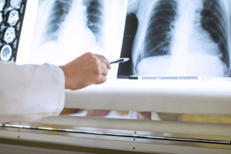 Schmuckbild: ine Hand mit Stift zeigt auf ein Detail in einem Röntgenbild einer Lunge; verlinkt zur Seite der 'Praxis für Pneumologie und Schlafmedizin'