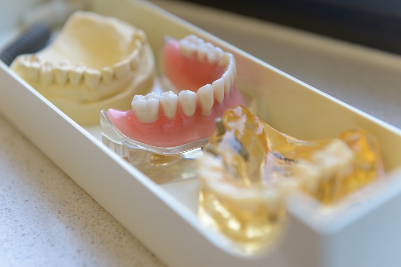 Kieferabdruck, Kiefermodell und Zahnprothese