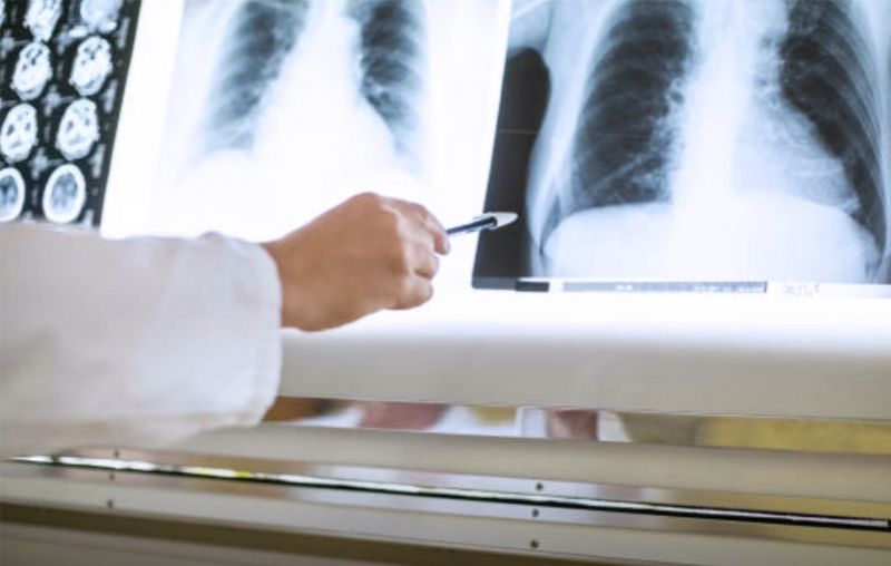 Schmuckbild: Hand eines Arztes zeigt mit einem Stift auf ein Röntgenbild von Brustkorb und Oberbauch (Bild: alvarez, istockphoto.com #811280878)