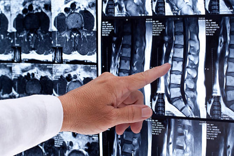 Schmuckbild: eine Hand zeigt auf ein Detail in einer MRT-Aufnahme der Wirbelsäule; verlinkt zur Seite der 'Praxis für Neurochirurgie'