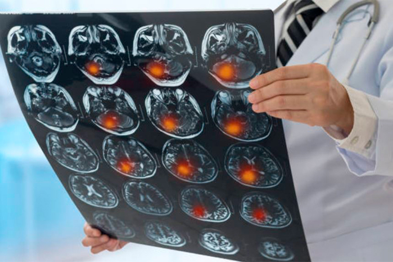 ein Arzt hält eine MRT-Aufnahme von einem Gehirn mit Tumor; verlinkt zur 'Neurologischen Tagesklinik'