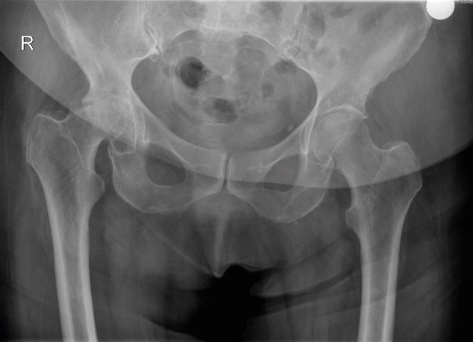 Röntgenbild, das einen schweren Verschleiß des Hüftgelenks zeigt