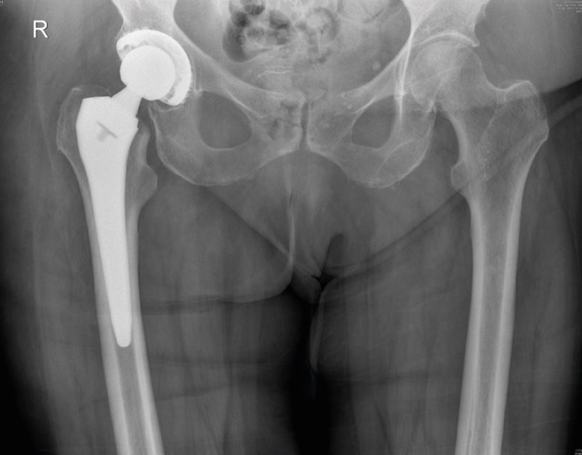 Röntgenbild, das die eingesetzte Hüftgelenksprothese an Stelle des verschlissenen Gelenks zeigt