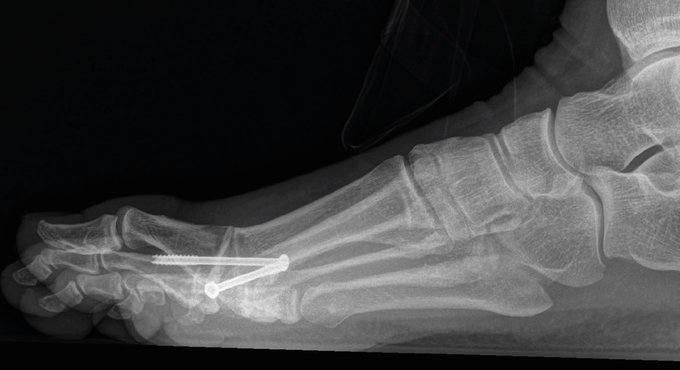 Röntgenbild des Fußes von der Seite, man sieht die beiden Schrauben, die das Grundgelenk der großen Zehe fixieren