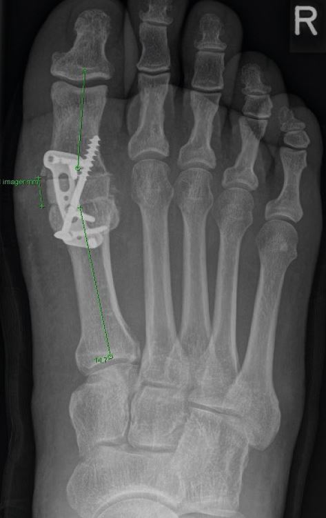 Röntgenbild des Fußes von oben, man sieht den eingesetzten Knochenspan sowie die Platten- und Schraubenkonstruktion, die ihn fixiert