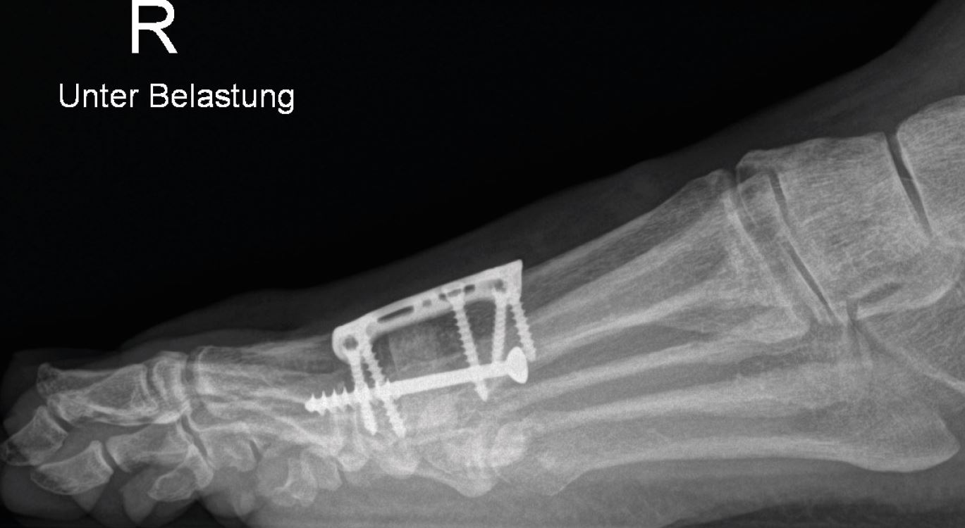 Röntgenbild des Fußes von der Seite, man sieht den eingesetzten Knochenspan sowie die Platten- und Schraubenkonstruktion, die ihn fixiert