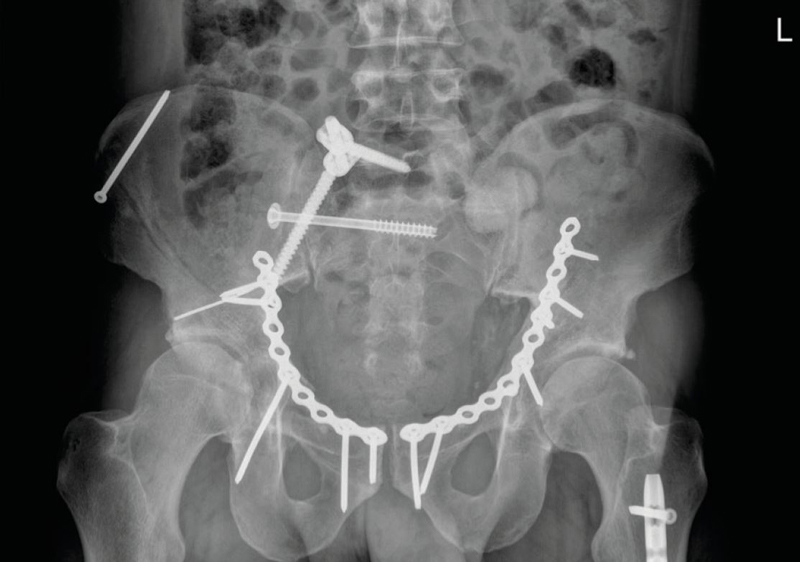 Röntgenaufnahme eines gebrochenen Beckens, in dem die Fragmente mit Schrauben und Drähten an der korrekten Position fixiert worden sind