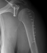 Röntgenbild eines Schultergelenks mit geschraubtem Bruch
