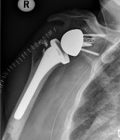 Röntgenbild einer Schultergelenksprothese