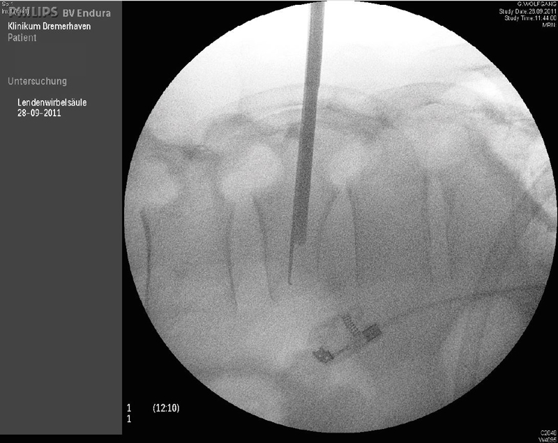 Intraoperatives Röntgenbild: minimal-invasives Einsetzen des Ballons in den Wirbelkörper