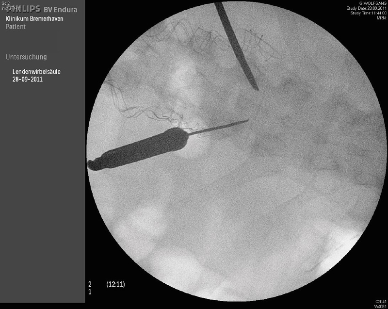 Intraoperatives Röntgenbild: minimal-invasives Ansetzen der Kanüle zur Befüllung mit Knochenzement