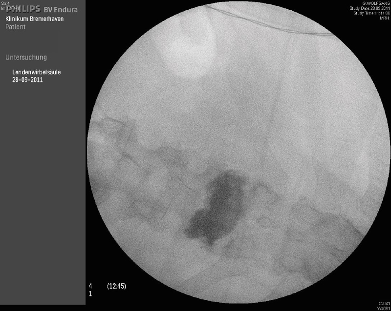 Intraoperatives Röntgenbild: zementierter Wirbelkörper