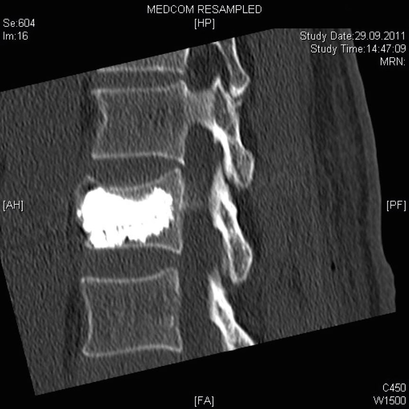 MRT-Aufnahme des zementierten Wirbelkörpers von der Seite