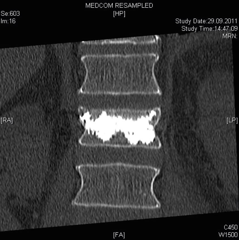MRT-Aufnahme des zementierten Wirbelkörpers von vorne