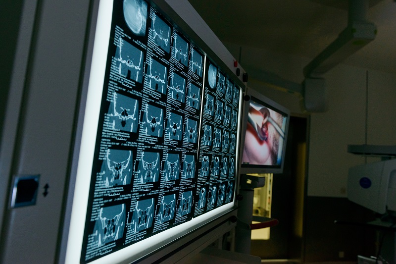 Szenenfoto aus dem Operationssaal, Monitore mit Bildgebung des Halsbereiches und mit dem Bild der Endoskopie-Kamera